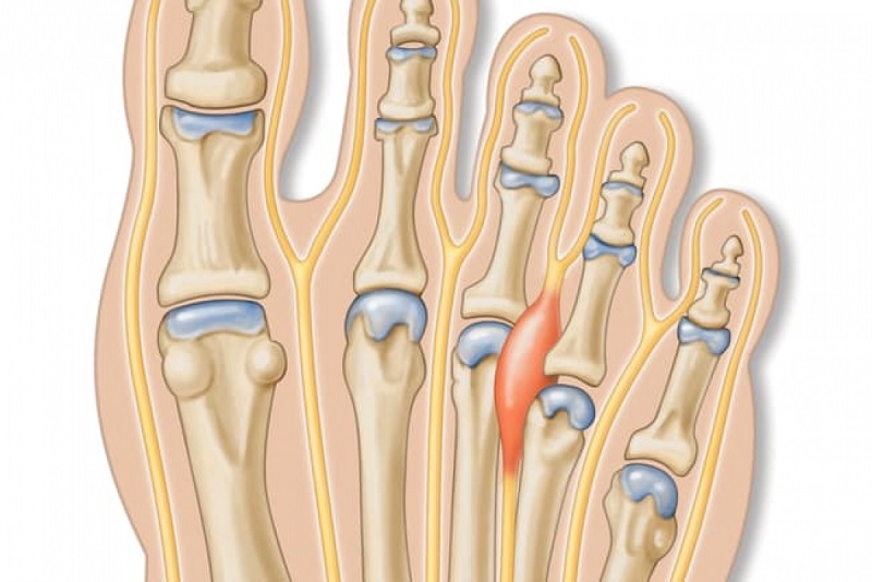 Bệnh đau thần kinh Morton khiến người bệnh cảm giác đau ở bàn chân