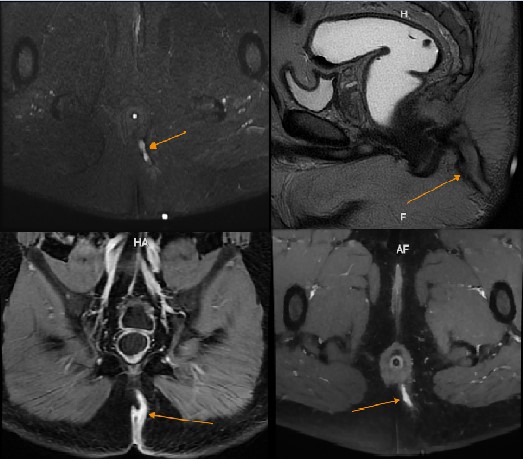 MRI giúp đánh giá một cách chi tiết, sắc nét về đường đi của đường rò hậu môn