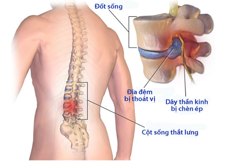  Bệnh về xương khớp là nguyên nhân phổ biến gây đau lưng mỏi gối tê tay