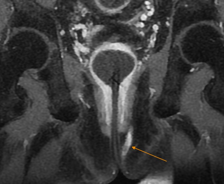 Đường rò hậu môn trên hình ảnh MRI