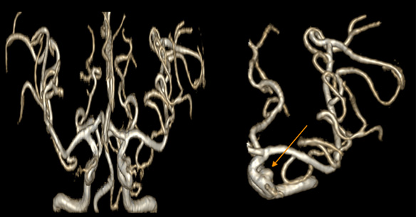 Hình ảnh túi phình động mạch não của một bệnh nhân vô tình phát hiện được khi chụp MRI tại Phòng Khám Medlatec Tây Hồ.