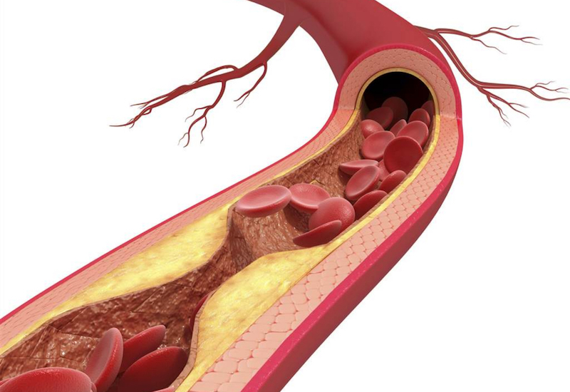 Các mảng xơ vữa trong lòng mạch là nguyên nhân dẫn đến bệnh động mạch cảnh