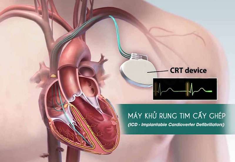 Máy ICD cấy ghép khử rung tim