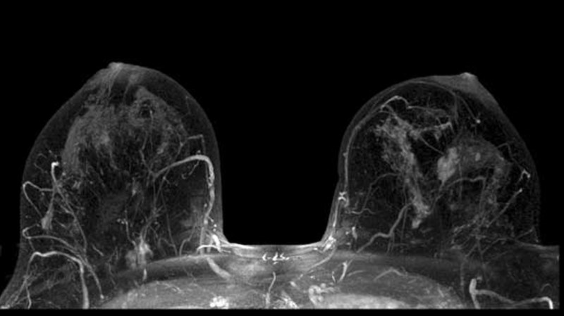 Hình ảnh MRI tuyến vú