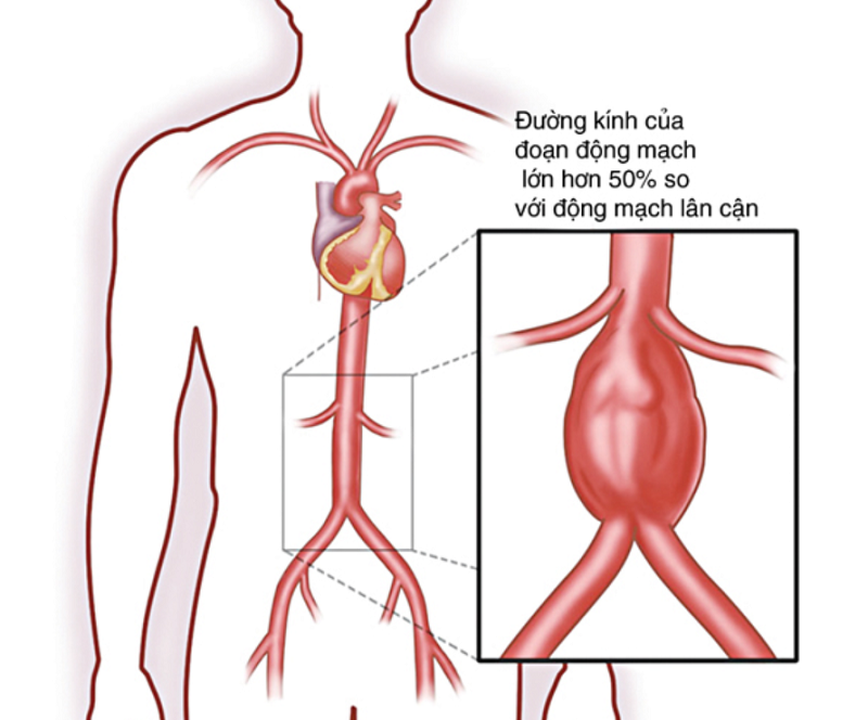 Động mạch chủ là động mạch chính, đưa máu đi khắp các bộ phận của cơ thể