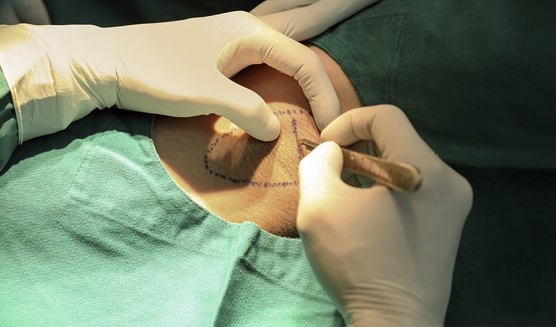 Phẫu thuật cắt tuyến mồ hôi nách diễn ra nhanh và khá an toàn khi thực hiện tại cơ sở y tế uy tín