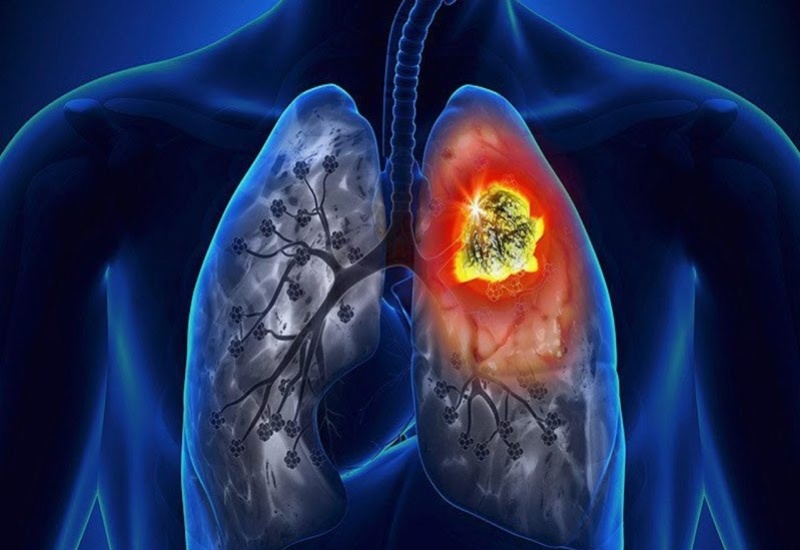 Đối tượng là người lớn có nguy cơ bị ung thư phổi khi hút thuốc lá thụ động