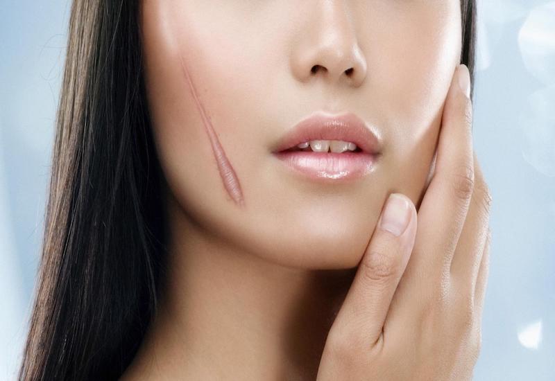 Sẹo lồi xuất hiện ở giai đoạn một thời gian sau khi cơ thể gặp phải chấn thương ngoài da