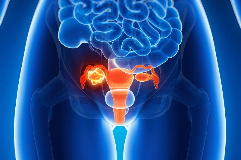 Ung thư tử cung có thể gây ra nhiều biến chứng nguy hiểm với nữ giới