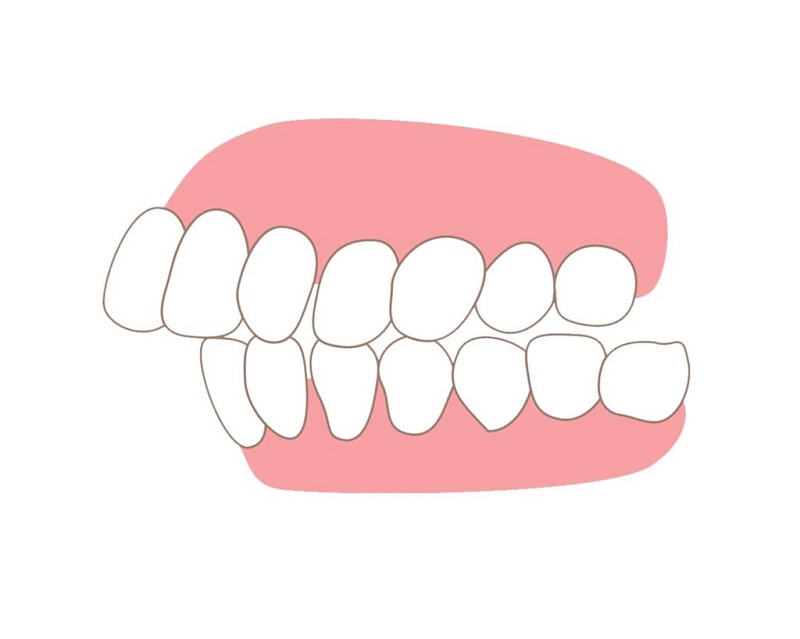 Răng hô khiến cho răng hàm trên lệch ra ngoài so với hàm bên dưới