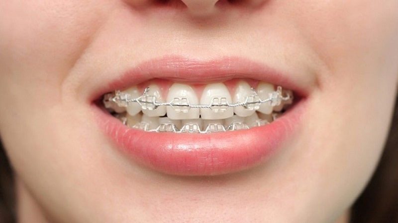 Niềng răng có thể khắc phục tình trạng răng hô