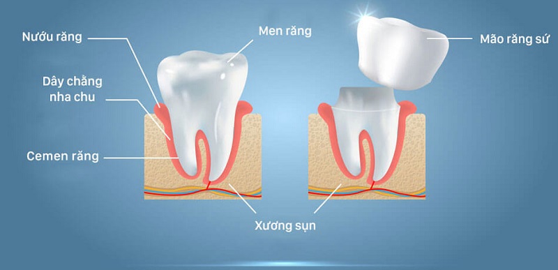 Mô phỏng về phương pháp bọc răng sứ