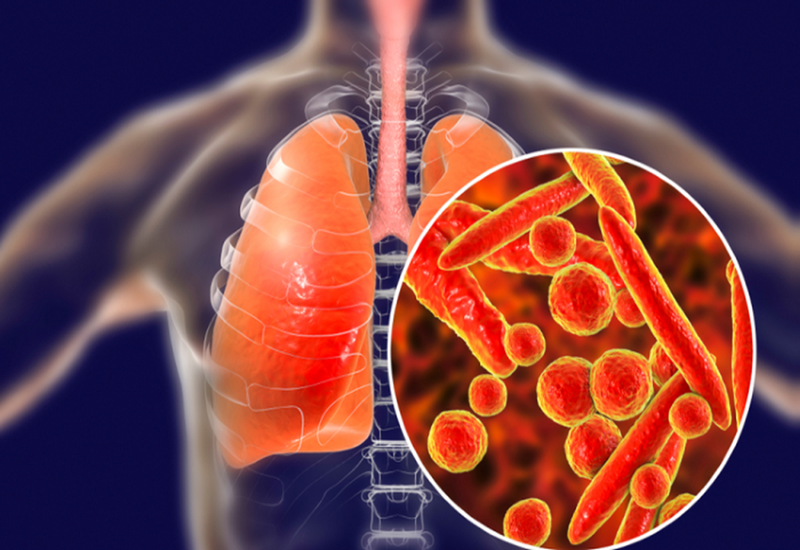 Lao phổi do vi khuẩn Tuberculosis