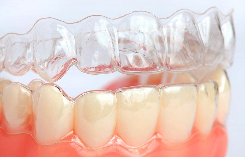 Niềng răng trong suốt sử dụng khay niềng bằng nhựa tạo cảm giác vô hình khi sử dụng