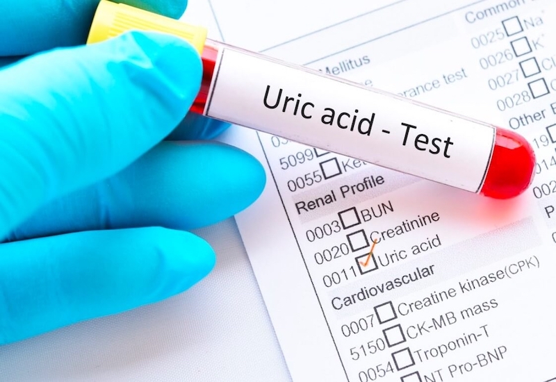 Xét nghiệm Uric acid máu cũng thuộc nhóm xét nghiệm sinh hóa máu quan trọng