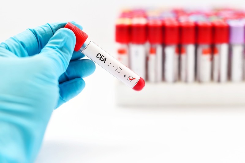 Xét nghiệm CEA là một trong những xét nghiệm quan trọng giúp phát hiện ung thư đường tiêu hóa                  