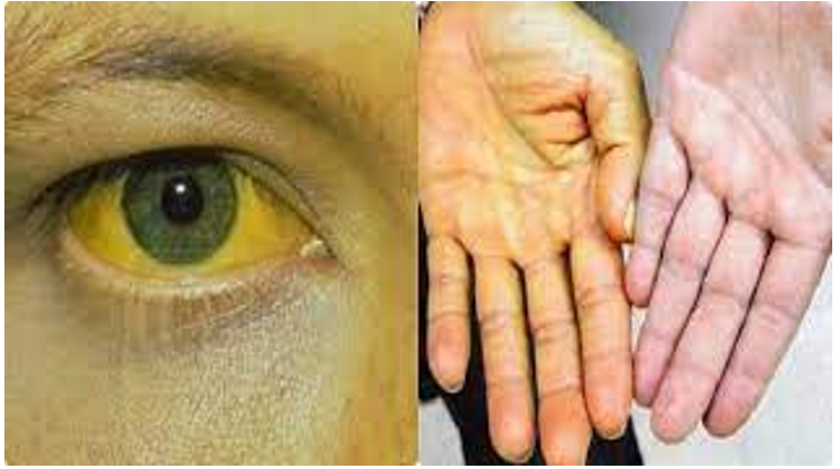 Vàng mắt và vàng da ở người mắc hội chứng vàng da tắc mật
