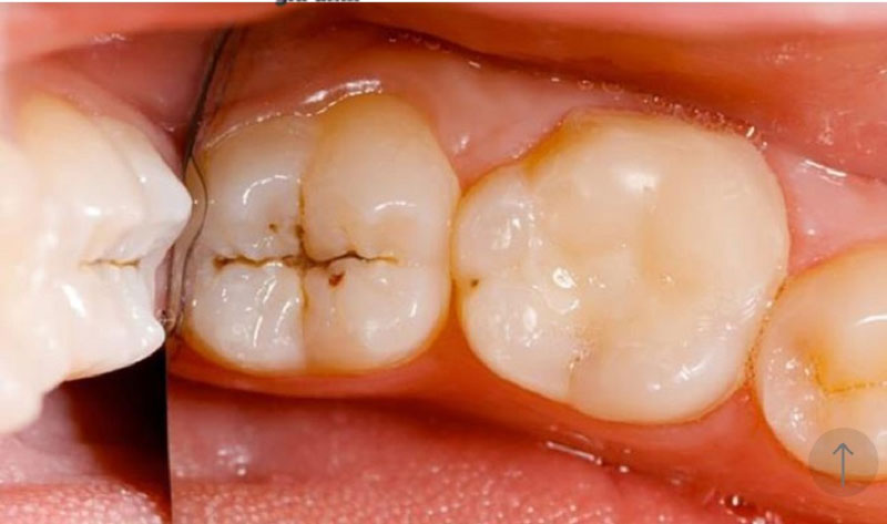Các răng xung quanh bị ố vàng do sâu răng lồi thịt