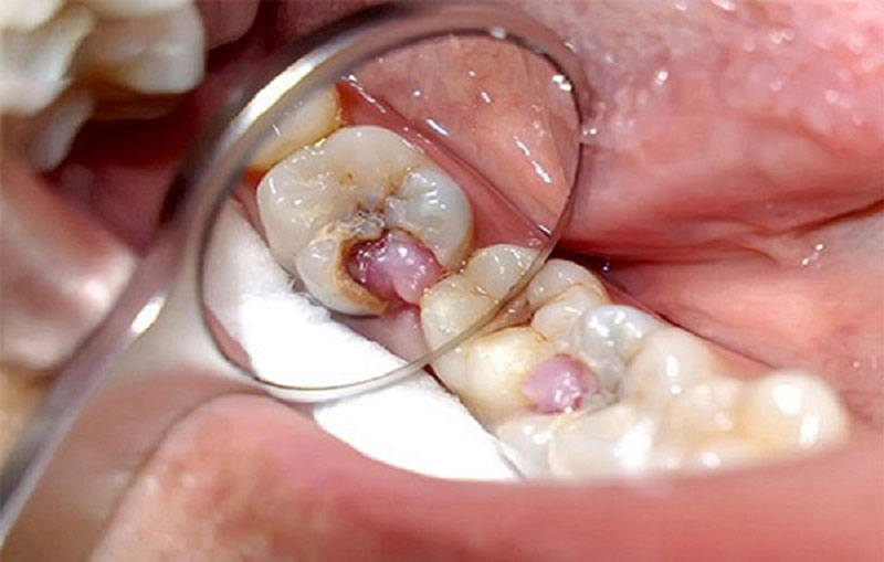 Điều trị răng sâu lồi thịt cần đến các cơ sở chuyên khoa uy tín