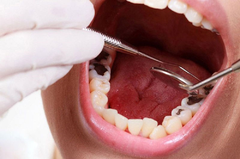 Khi răng có dấu hiệu bị sâu cần tiến hành điều trị càng sớm càng tốt
