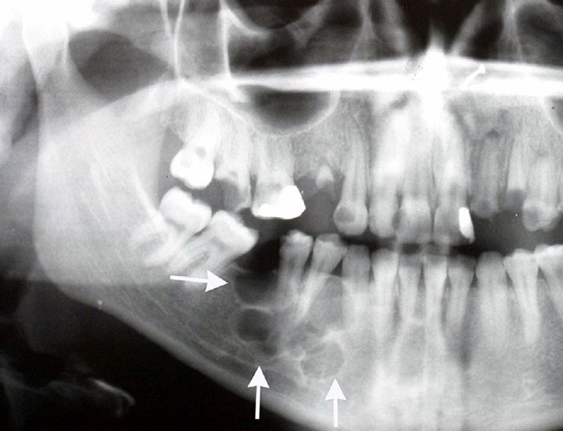 Kỹ thuật chẩn đoán ung thư răng hàm mặt bằng chụp X- quang