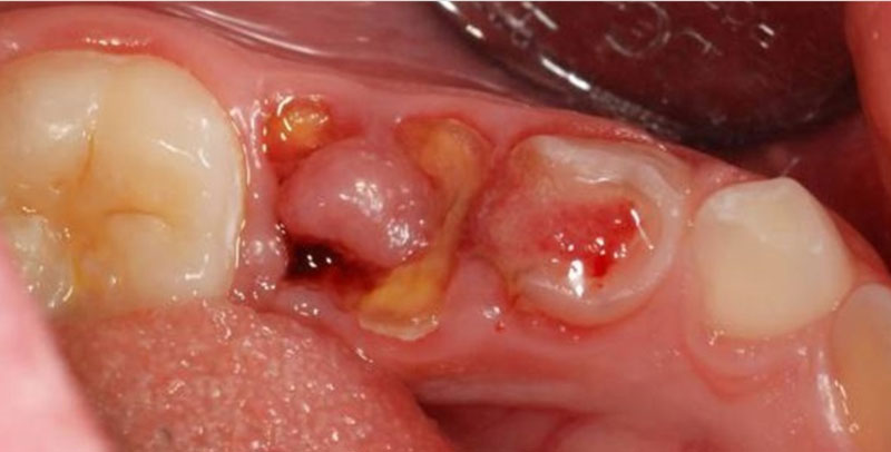 Sâu răng lồi thịt khiến răng và nướu bị viêm cấp tính nghiêm trọng