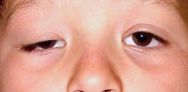 Sụp mí mắt bẩm sinh thường là vì bị rối loạn và thay đổi kết cấu một cách khác thường của những sợi cơ có tác dụng nâng mí