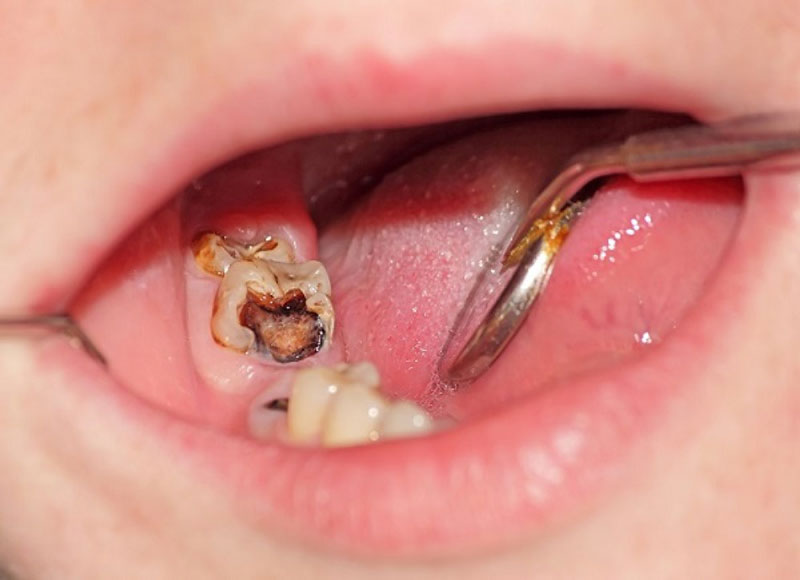 Khi tủy răng đã chết, bệnh nhân không còn cảm nhận đau hay khó chịu khi ăn đồ nóng, lạnh