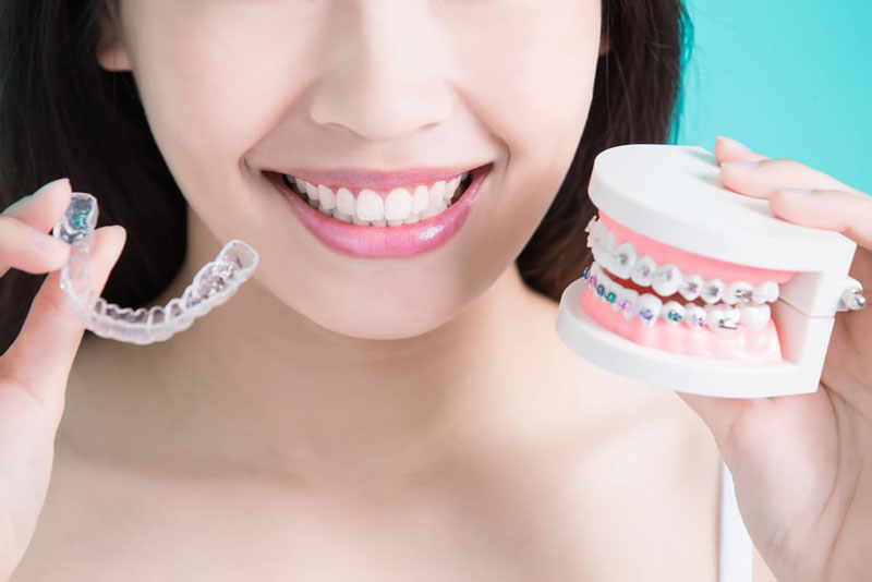 Niềng răng giúp bạn sở hữu hàm răng đều, đẹp hơn