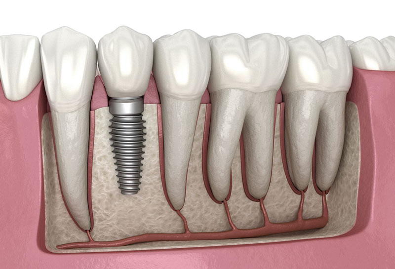 Trồng răng Implant là phương pháp tốt nhất để ngăn chặn tiêu xương hàm