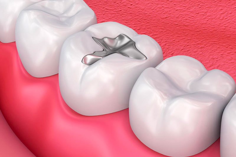 Amalgam cũng được sử dụng phổ biến khi trám răng