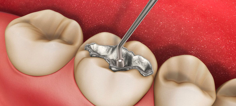 Hàn răng là kỹ thuật điều trị, khôi phục chức năng của răng