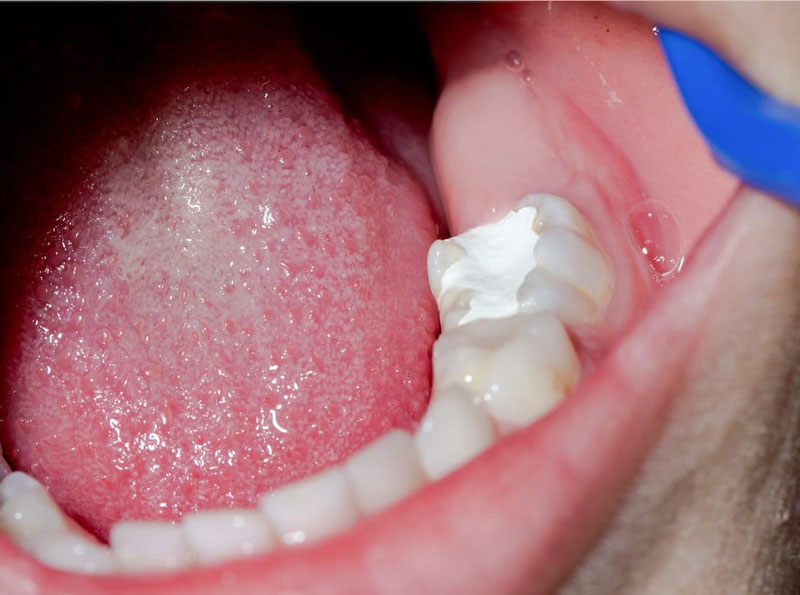 Hàn răng là một trong những phương pháp bảo vệ sức khỏe răng miệng