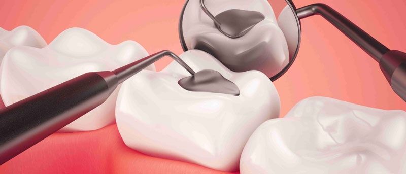 Những loại vật liệu hàn răng được sử dụng phổ biến hiện nay