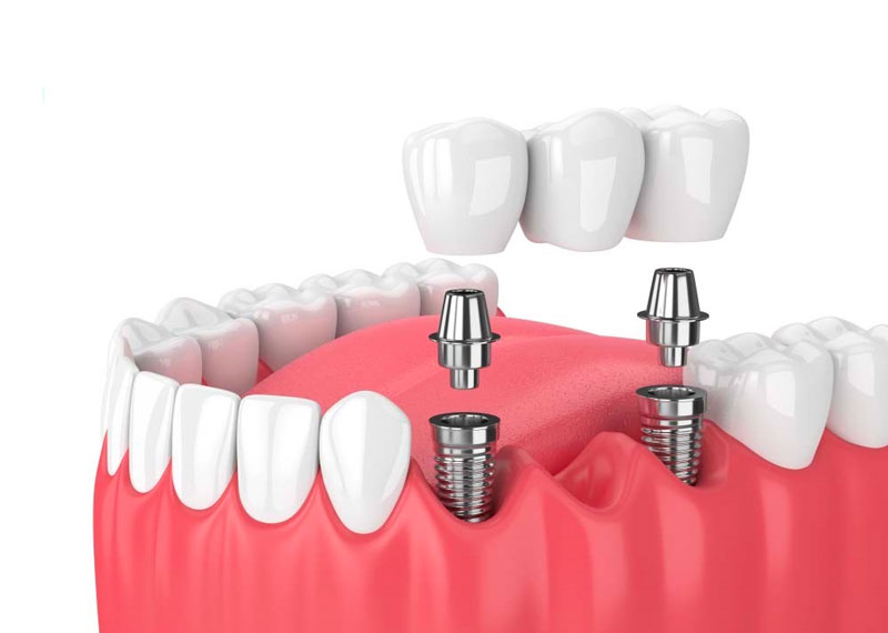 Phương pháp trồng Implant giúp giải quyết khoảng trống do mất răng