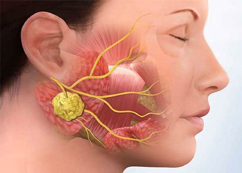 U ác tuyến mang tai là một dạng của u tuyến nước bọt
