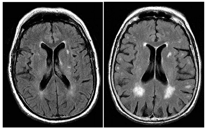 Chụp MRI sọ não có thể phát hiện rất nhiều tổn thương nhu mô não