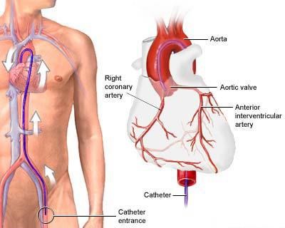 Hình ảnh mô tả phương pháp Coronary Angiogram đi từ động mạch