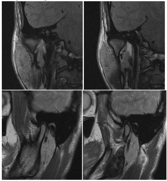 Hình ảnh chụp MRI khớp thái dương hàm tại bệnh viện MEDLATEC