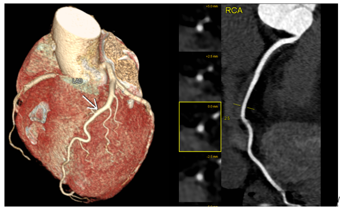 Hình ảnh chụp MSCT mạch vành tại bệnh viện MEDLATEC