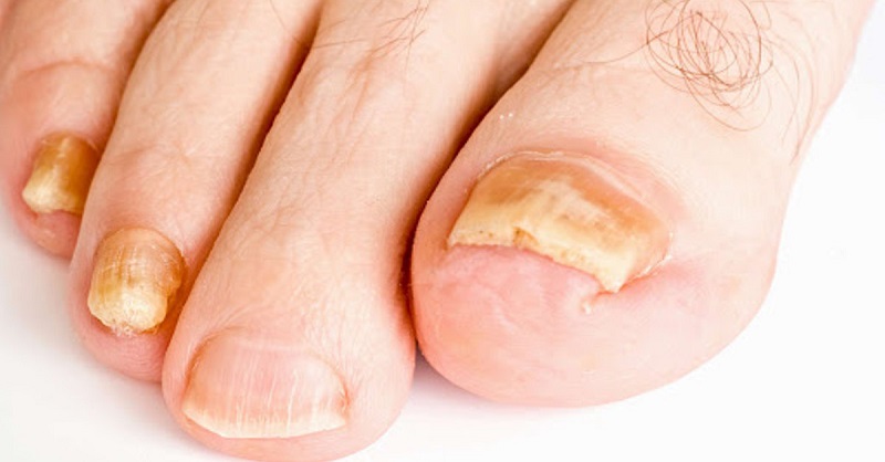 Nứt móng tay chân, móng đục và mủn là dấu hiệu của bệnh nấm móng