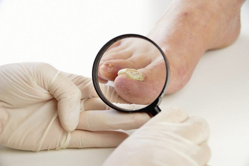 Bị nứt móng tay chân kéo dài cần khám bác sĩ chuyên khoa để chẩn đoán xác định và điều trị sớm