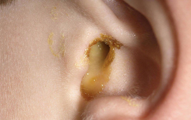 Viêm tai giữa có thể gây ra tình trạng chảy dịch tai