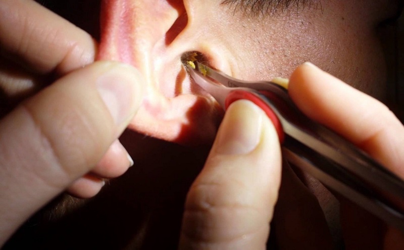 Việc xử lý côn trùng chui vào tai cần được xử lý sớm tránh gây ảnh hưởng đến vùng tai