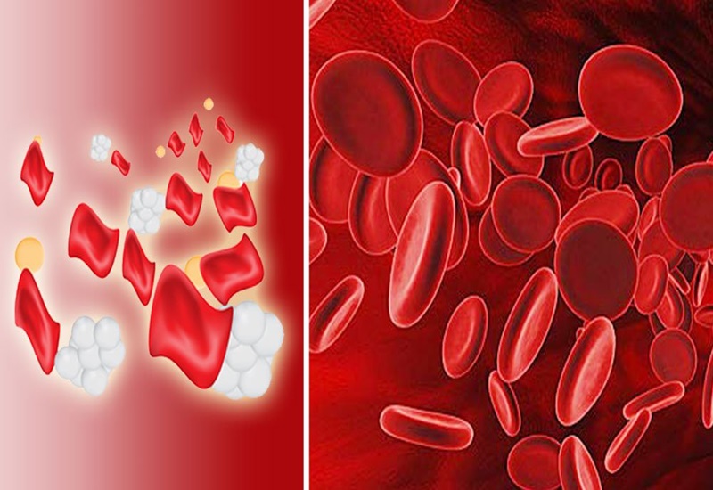 Thiếu máu do bệnh lý có thể gây nguy hiểm cho người bệnh