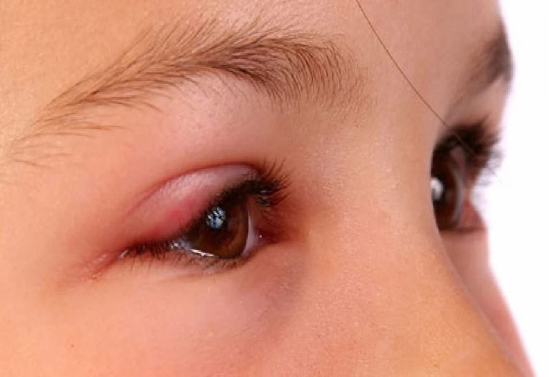 Viêm bờ mi là hiện tượng vùng mí mắt ở chân lông mi của trẻ bị viêm