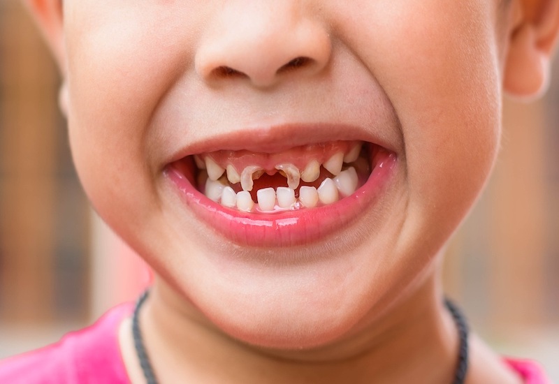 Sâu răng sữa có thể ảnh hưởng đến răng vĩnh viễn sau này