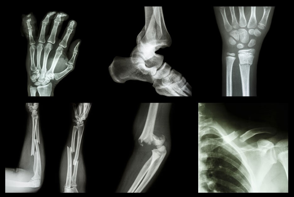 X-quang giúp đánh giá rất tốt tình trạng gãy xương