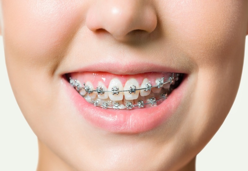 Niềng răng là một trong những cách giúp có được khớp cắn chuẩn