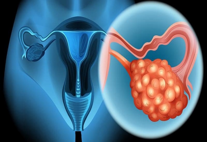 Ung thư buồng trứng là một trong các bệnh lý ác tính nguy hiểm ở nữ giới 